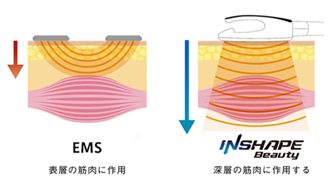 圧倒的インパクトの高密度電磁パルステクノロジーとは？